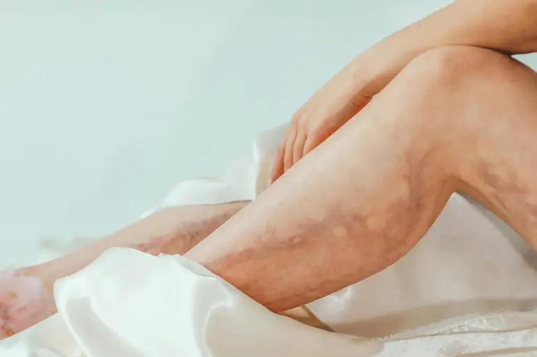 proširene vene na nogama proširene vene na nogama